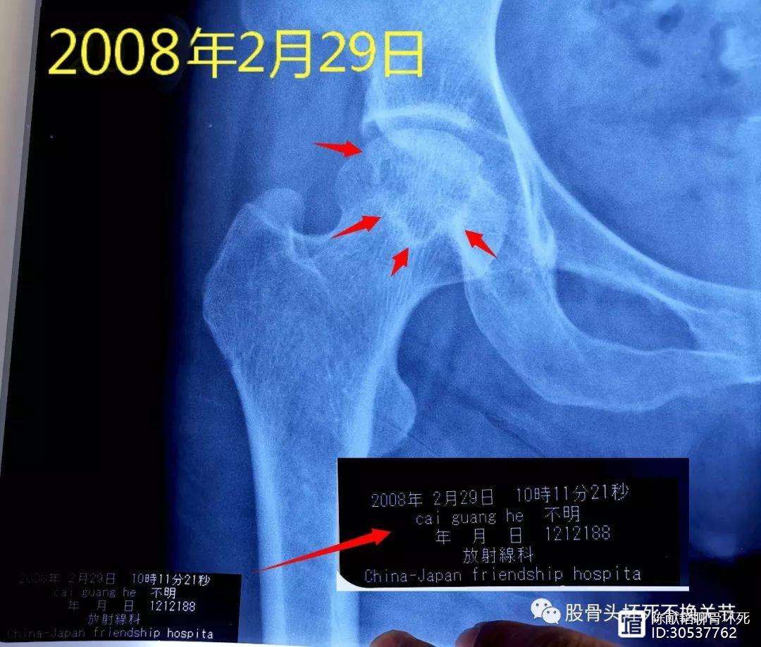 绍兴人工骨头医保报销多少(人工骨头医保报销多少比例)