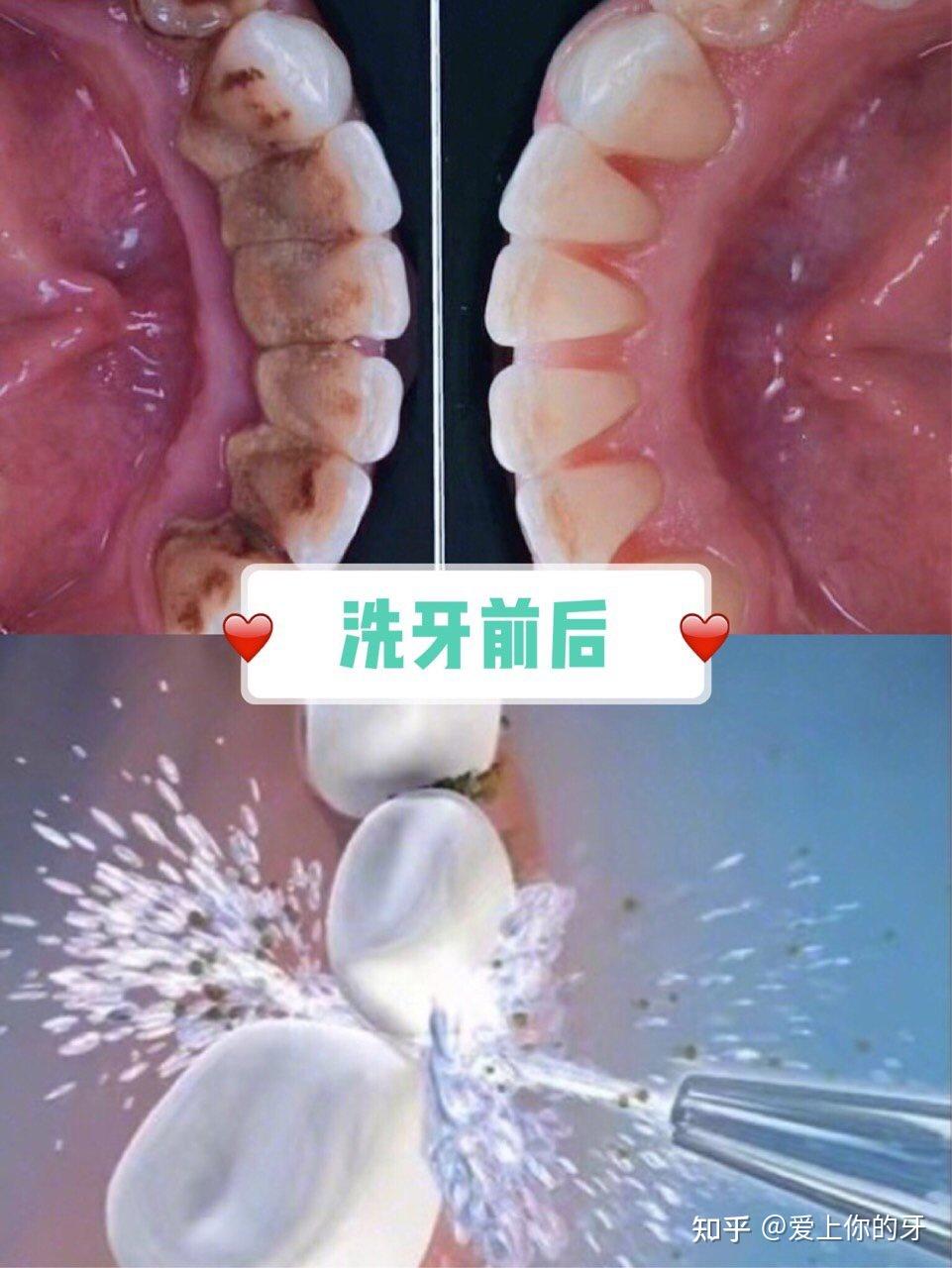 绍兴洗牙可以用医保吗(洗牙可以用医保吗,报销比例多少)